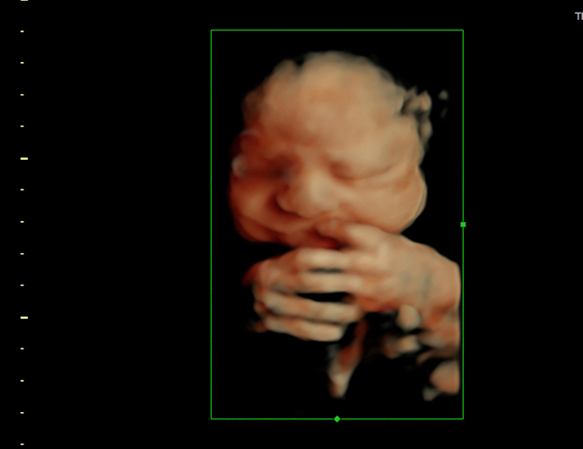 3D ultrasound image at 29 weeks